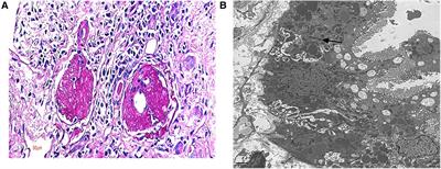 Clinical features and gene variation analysis of COQ8B nephropathy: Report of seven cases